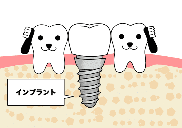 インプラントを用いた治療法